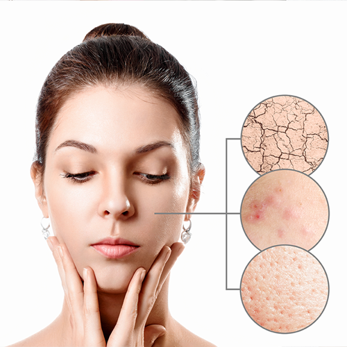 Acne Scars Treatment