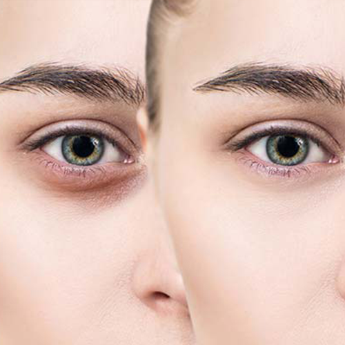 Dark Circles Treatment